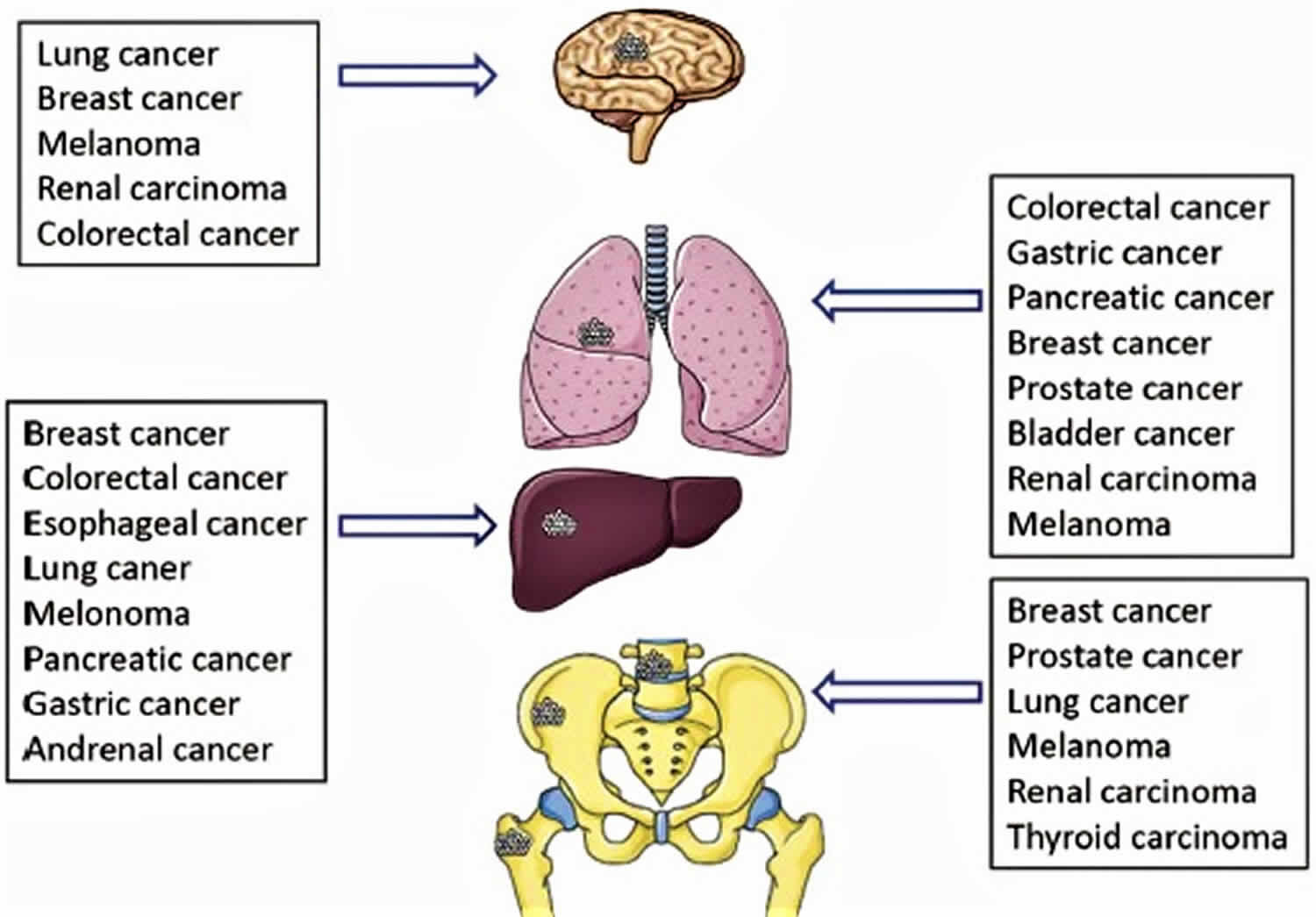 Cure For Metastatic Cancer