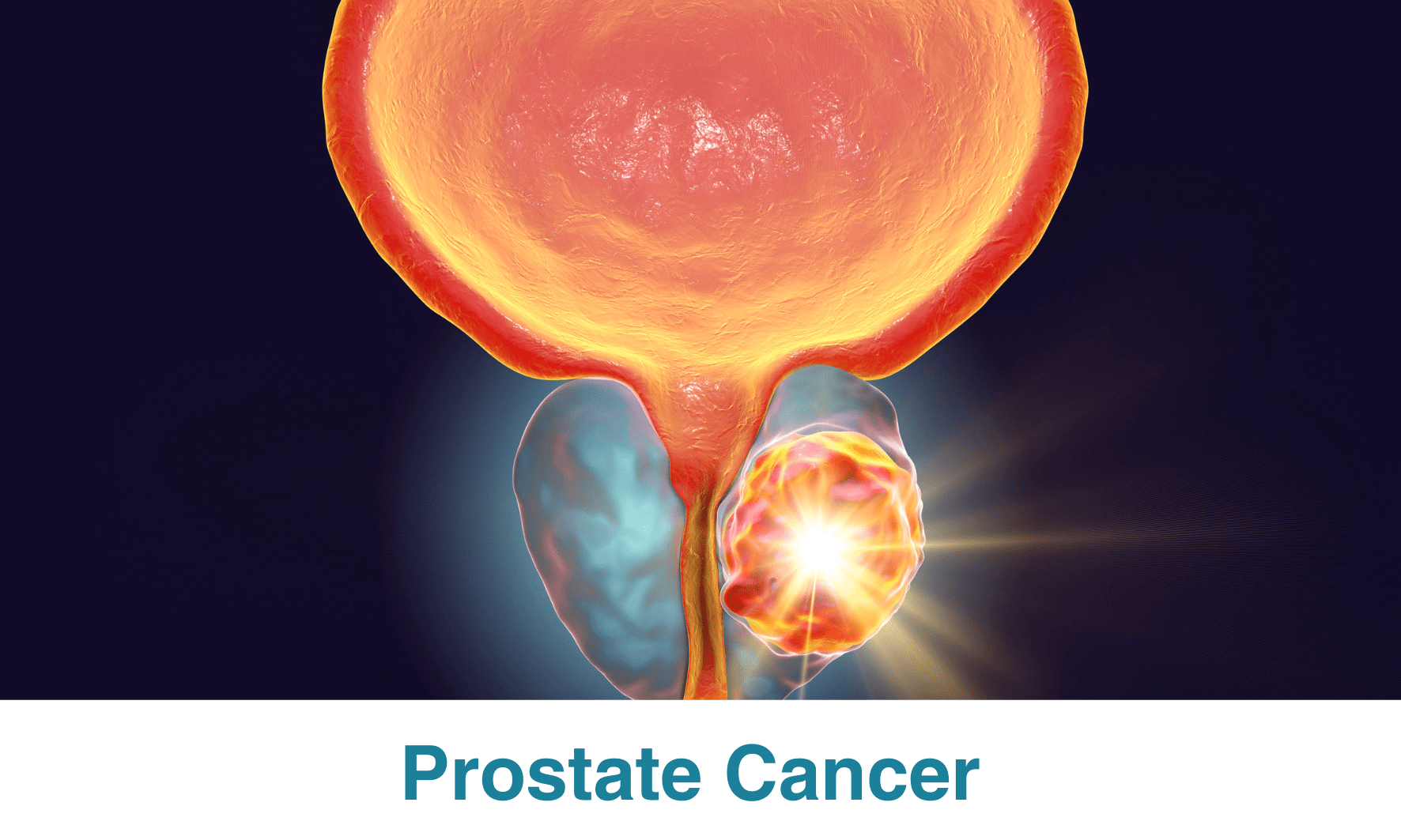 Hrr Mutation Prostate Cancer